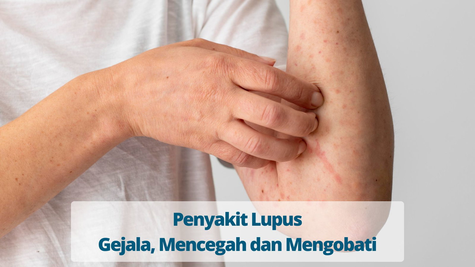 Perhatikan Empat Gejala Penyakit Lupus Berikut Ini, Jika Mengalami Segera Periksa ke Dokter