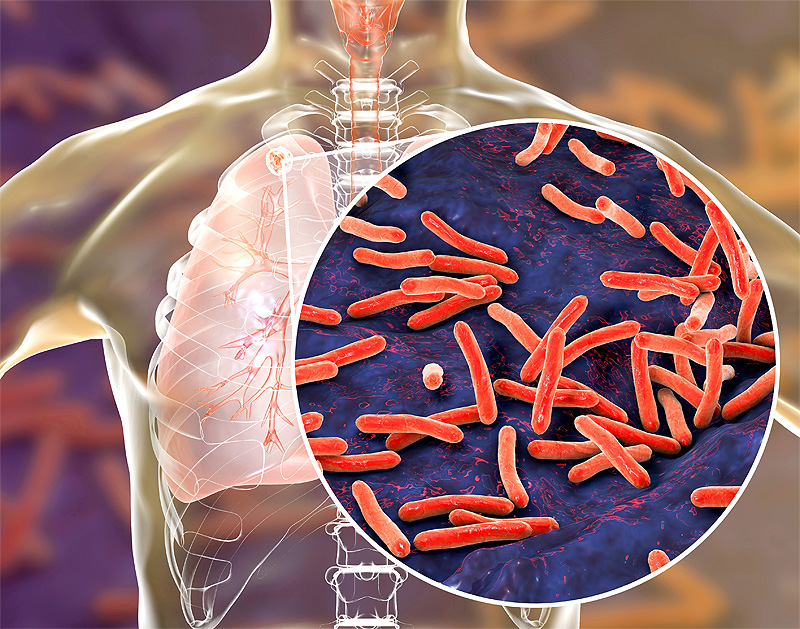 Mayoritas Pasien Tuberculosis Berisiko Kurang Gizi: Pemenuhan Nutrisi Bisa Percepat Pemberantasan