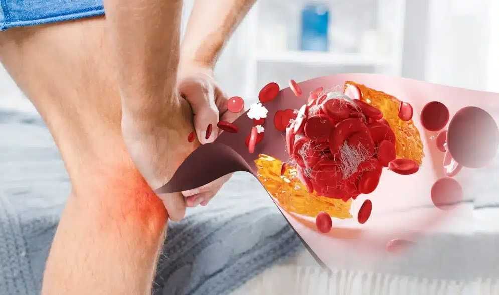 Risiko Asam Urat Meningkat Akibat Pangan Ultraproses dan Obesitas
