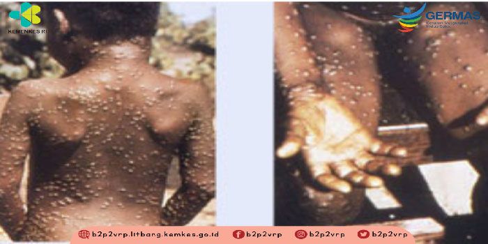 Mengenali Apa Itu Cacar Monyet atau MPox Hingga WHO Menetapkan dalam Status Gawat Darurat