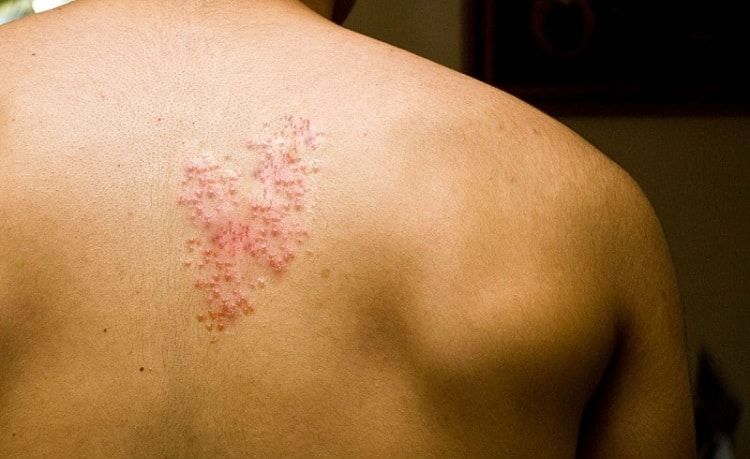 Memasuki Musim Pancaroba Rawan Penularan Penyakit Herpes Zoster, Ini Dia Gejalanya