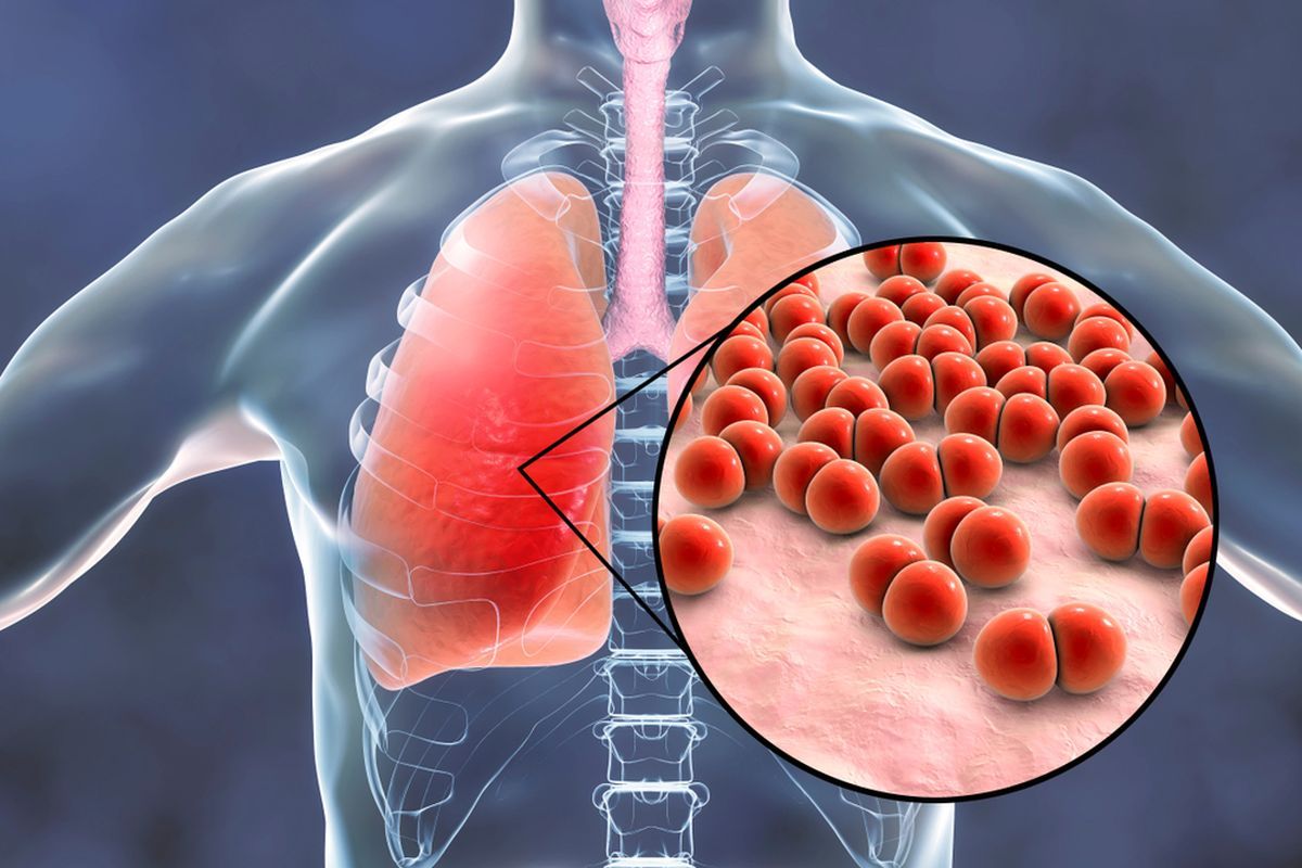 Mengenal Pneumonia: Penyakit yang Menyebabkan Meninggalnya Dua Artis Top Dunia
